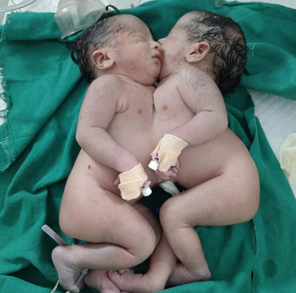 हरिद्वार में पहली बार पैदा हुए आपस में चिपके हुए जुड़वा बच्चे , जच्चा बच्चा तीनो सुरक्षित 1 IMG-20230315-WA0024